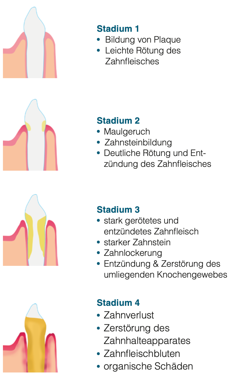 Entwicklungsstadien von Parodontalerkrankungen